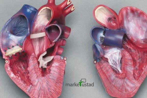 Everything You Need to Know About Heart Disease