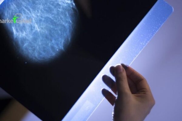 How to Understand the Stages of Breast Cancer